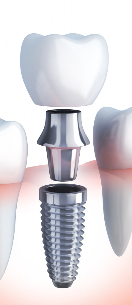 dentalImplant-Cropped.jpg